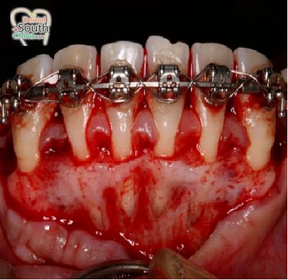 正畸骨皮质切开术视频，术式要点如何直观呈现？-图2