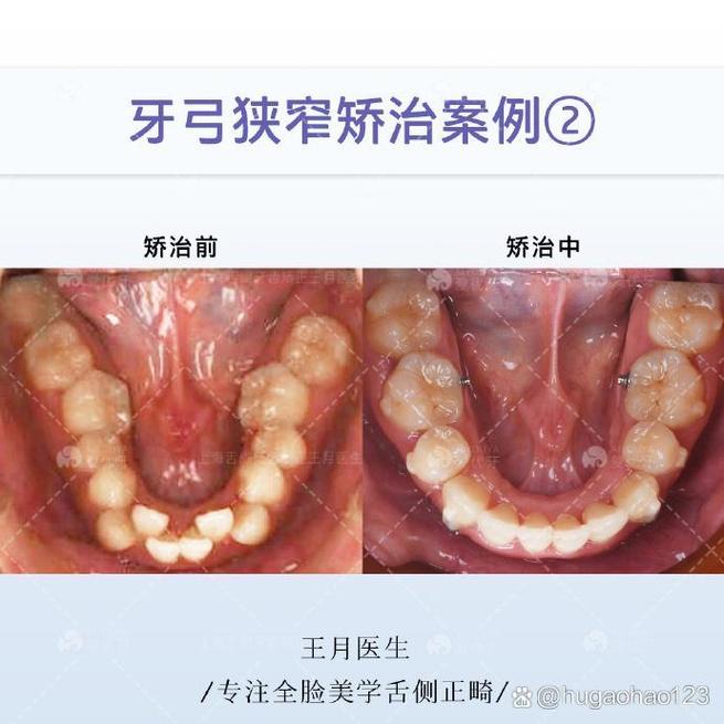 错合畸形的治疗方法有哪些?如何根据畸形类型选择?-图3 错合畸形的治疗方法有哪些?如何根据畸形类型选择?-图3