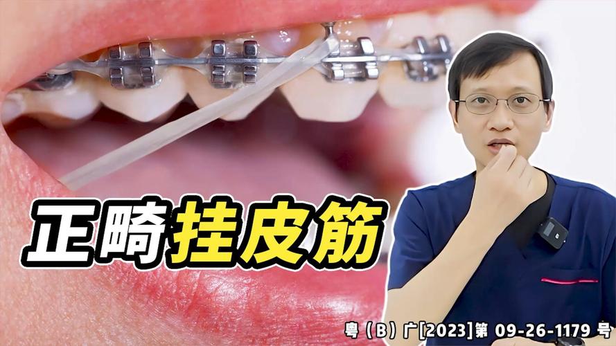 牙科正畸放橡皮筋视频该怎么操作？-图1