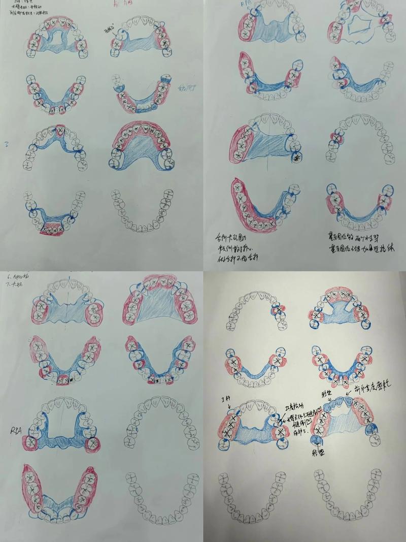 颌骨缺损重建方法如何选择?关键影响因素与临床策略是什么?-图2 颌骨缺损重建方法如何选择?关键影响因素与临床策略是什么?-图2
