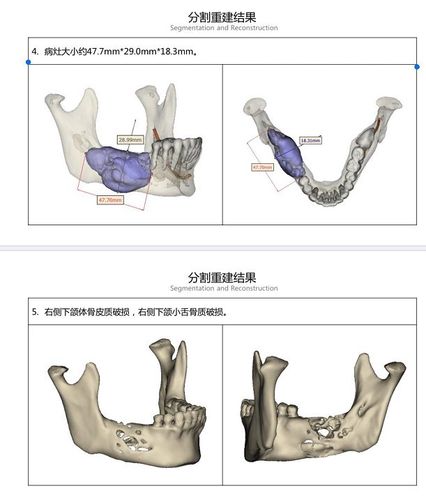 颌骨缺损重建方法如何选择?关键影响因素与临床策略是什么?-图1 颌骨缺损重建方法如何选择?关键影响因素与临床策略是什么?-图1