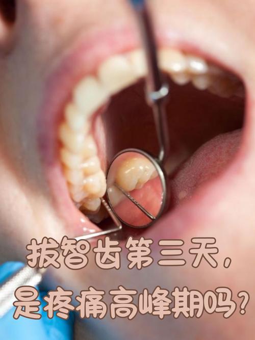 拔牙后正畸牙齿会疼吗-图2 拔牙后正畸牙齿会疼吗-图2