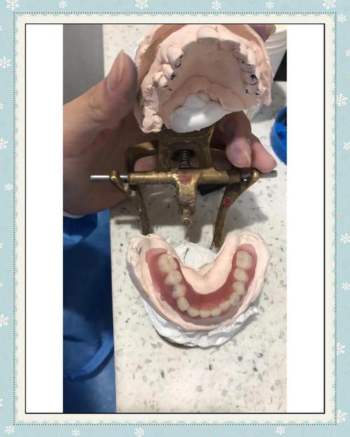 临时牙制作方法图片-图3 临时牙制作方法图片-图3