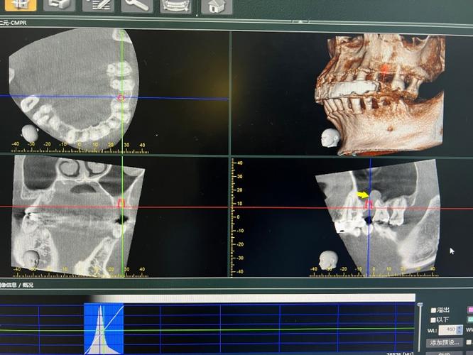 种牙植体穿过上鼻窦-图1