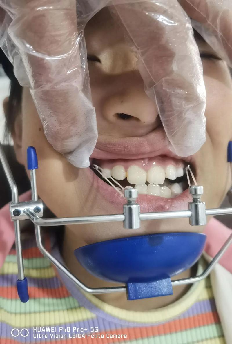 面弓矫正的使用方法是什么？正确操作步骤与注意事项详解-图1