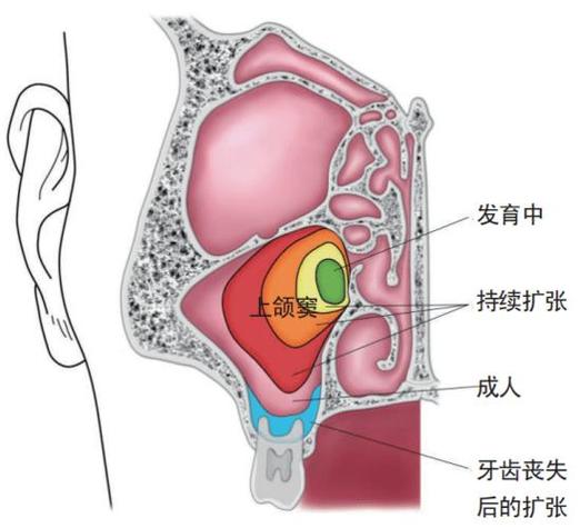 上颌窦底提升术常用方法有哪些?如何根据患者情况选择最佳术式?-图1 上颌窦底提升术常用方法有哪些?如何根据患者情况选择最佳术式?-图1
