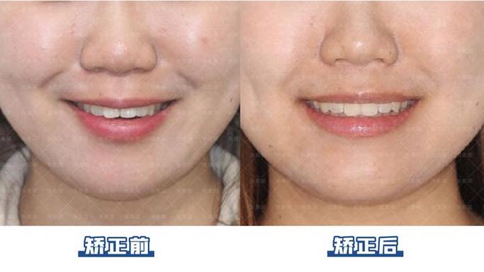 开颌术前必须正畸吗？-图2