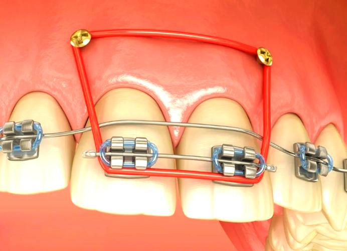 牙齿正畸为何用上皮筋?作用揭秘-图2 牙齿正畸为何用上皮筋?作用揭秘-图2