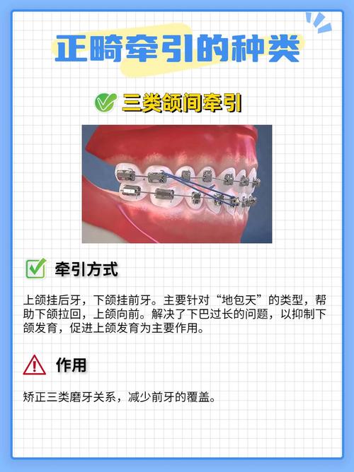 牙齿正畸为何用上皮筋?作用揭秘-图3 牙齿正畸为何用上皮筋?作用揭秘-图3