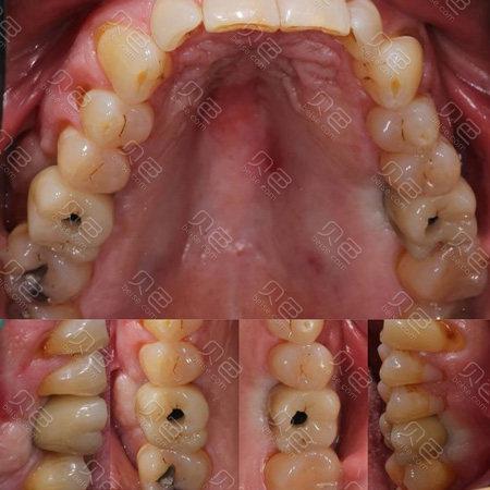 种牙后牙冠高度不够是什么原因？该如何处理？-图3