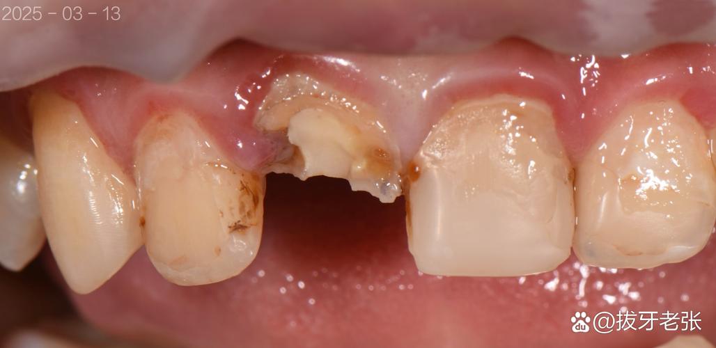 种牙后牙冠高度不够是什么原因?该如何处理?-图1 种牙后牙冠高度不够是什么原因?该如何处理?-图1