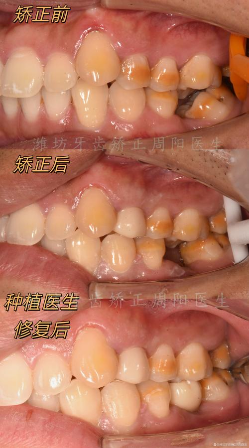 种牙后临时修复有何作用?护理要点与注意事项有哪些?-图1 种牙后临时修复有何作用?护理要点与注意事项有哪些?-图1
