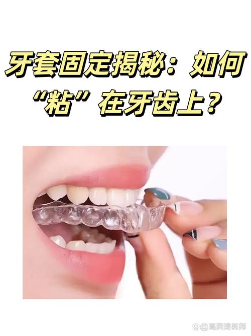 牙齿粘托槽矫正方法如何操作?详细步骤和注意事项有哪些?-图1 牙齿粘托槽矫正方法如何操作?详细步骤和注意事项有哪些?-图1