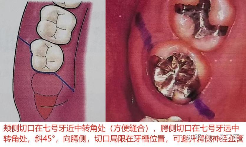 智齿弯根拔出难不难？具体方法和步骤是怎样的？-图2