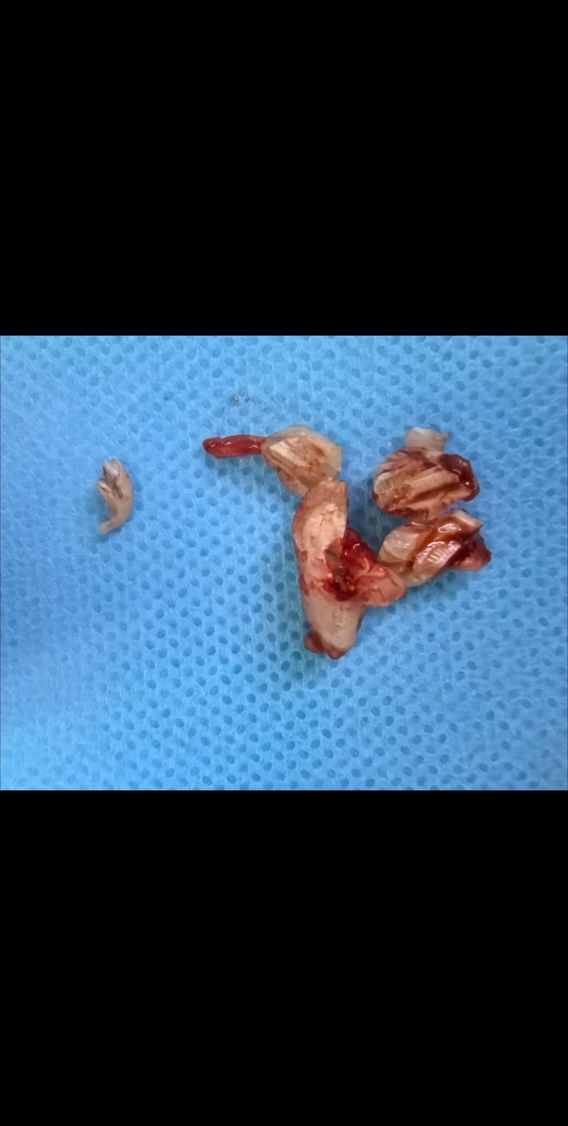 智齿弯根拔出难不难？具体方法和步骤是怎样的？-图1