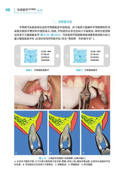 牙科粘骨牙拔除方法有哪些?难点与操作技巧是什么?-图1 牙科粘骨牙拔除方法有哪些?难点与操作技巧是什么?-图1
