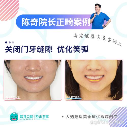 湘雅口腔正畸主治医生怎么选？资质与效果如何？-图3
