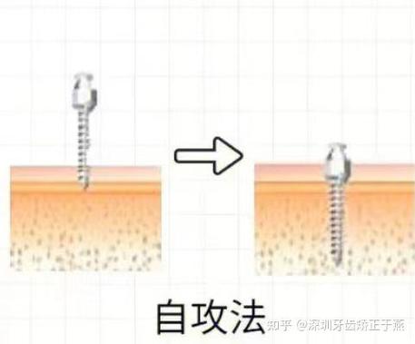 判断种植钉松动方法-图2 判断种植钉松动方法-图2