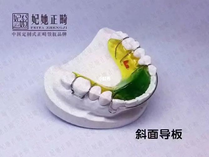 正畸斜导佩戴时间一般需要戴多久合适?-图1 正畸斜导佩戴时间一般需要戴多久合适?-图1