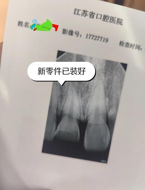 门牙断裂后如何修复?有哪些常用修复方法?-图2 门牙断裂后如何修复?有哪些常用修复方法?-图2