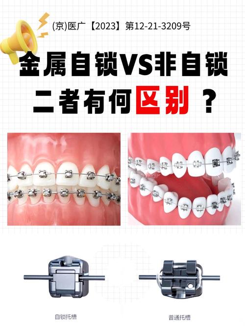 自锁托槽的安装方法-图3