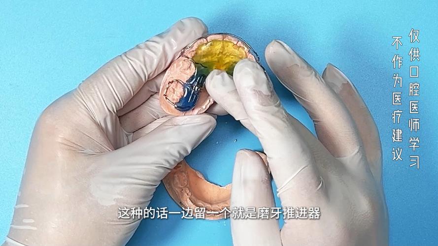 磨牙推进器如何正确安装?步骤与要点是什么?-图2 磨牙推进器如何正确安装?步骤与要点是什么?-图2