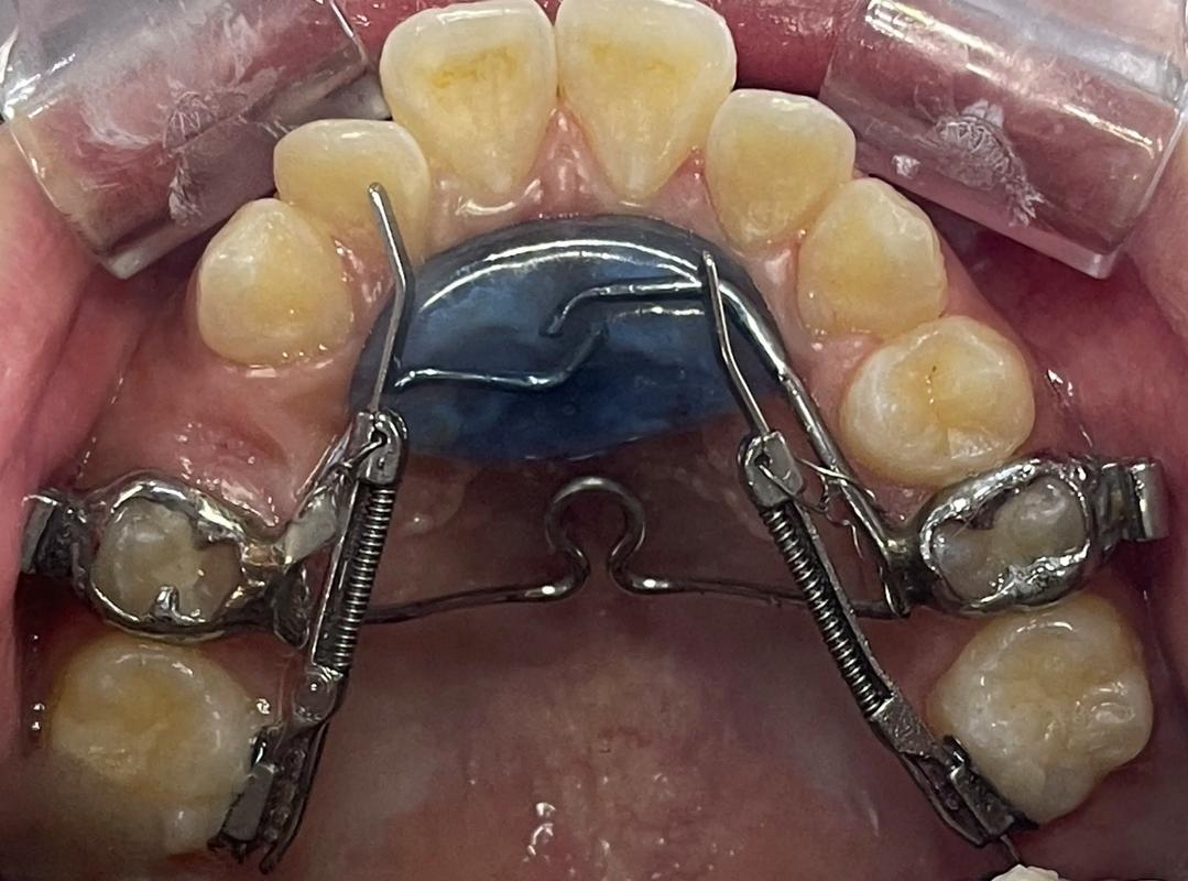 磨牙推进器如何正确安装?步骤与要点是什么?-图1 磨牙推进器如何正确安装?步骤与要点是什么?-图1