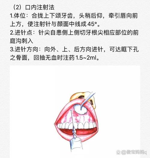 口腔科常用麻醉方法-图2
