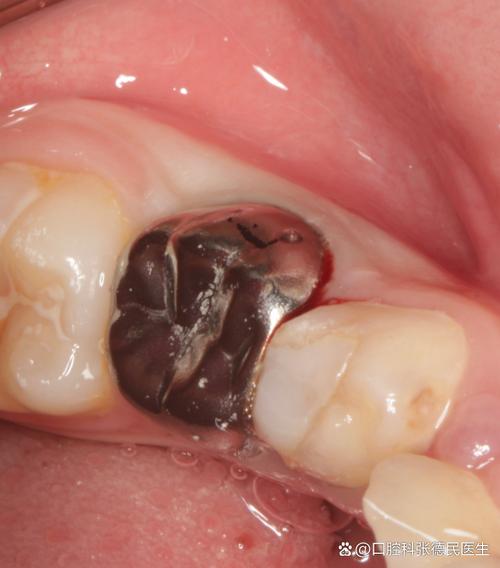 正畸之后门牙缝有黑点，是什么原因导致的？-图3