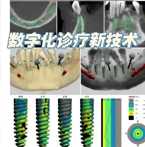 先进的数字化正畸技术-图3 先进的数字化正畸技术-图3