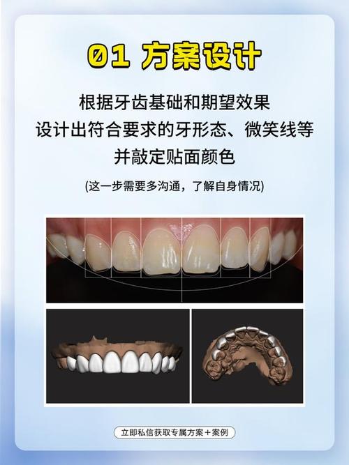 如何规范操作临时瓷贴面粘接？方法步骤是什么？-图1