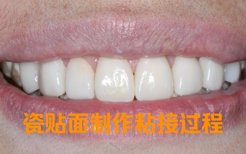 如何规范操作临时瓷贴面粘接？方法步骤是什么？-图2