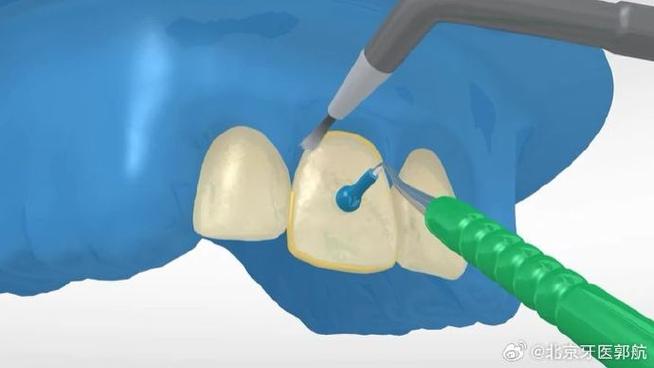如何规范操作临时瓷贴面粘接？方法步骤是什么？-图3