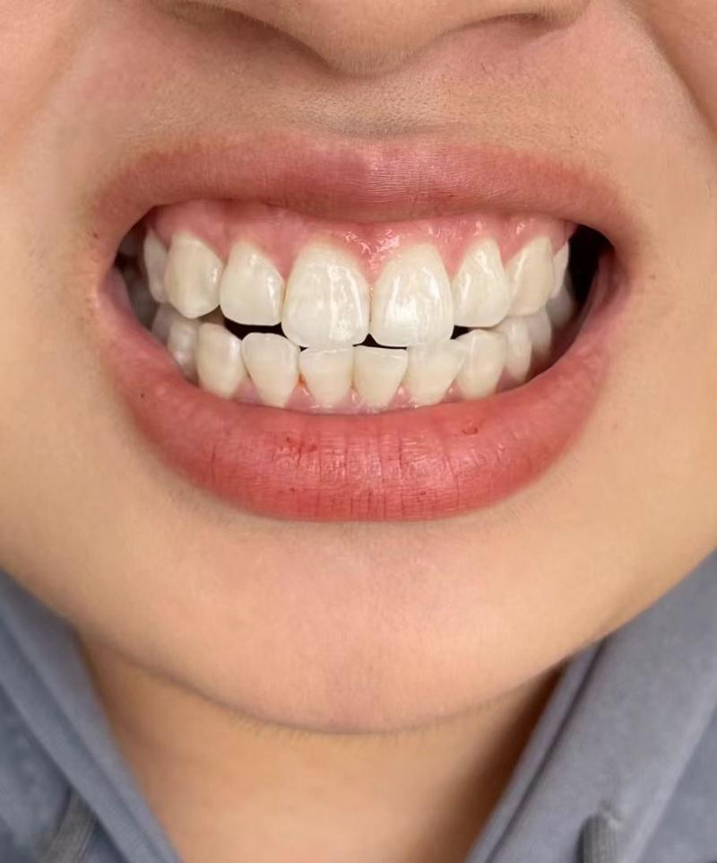 种牙失败有什么症状-图2