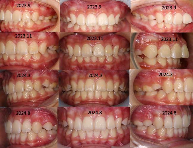 正畸时拍的照片叫什么?-图2 正畸时拍的照片叫什么?-图2