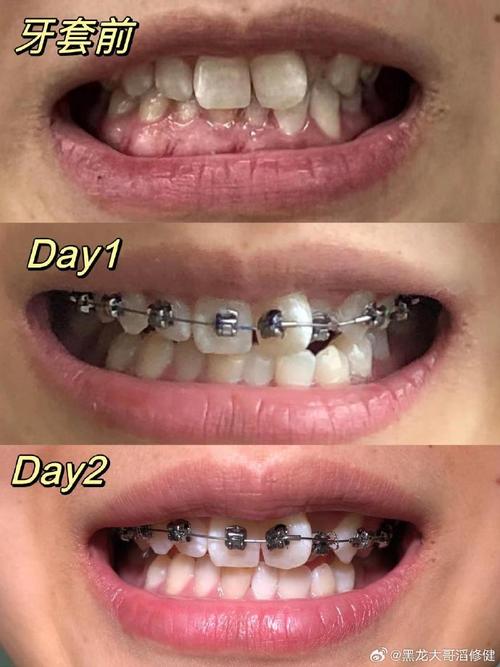 正畸时拍的照片叫什么?-图3 正畸时拍的照片叫什么?-图3