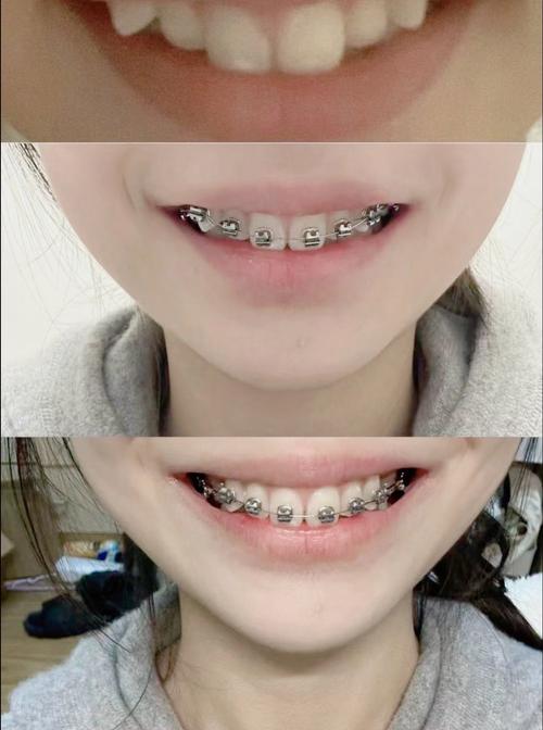 北京口腔王府井 正畸-图1 北京口腔王府井 正畸-图1