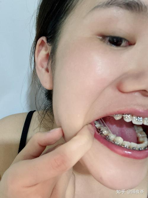 正畸拔牙会导致脸塌吗？-图2