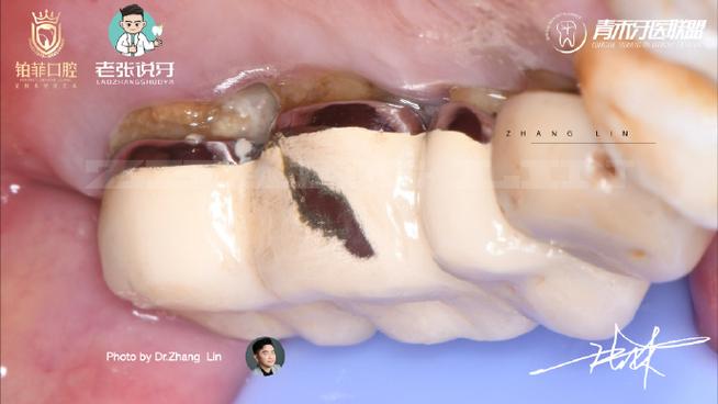拆下烤瓷牙后,还能做正畸治疗吗?-图1 拆下烤瓷牙后,还能做正畸治疗吗?-图1