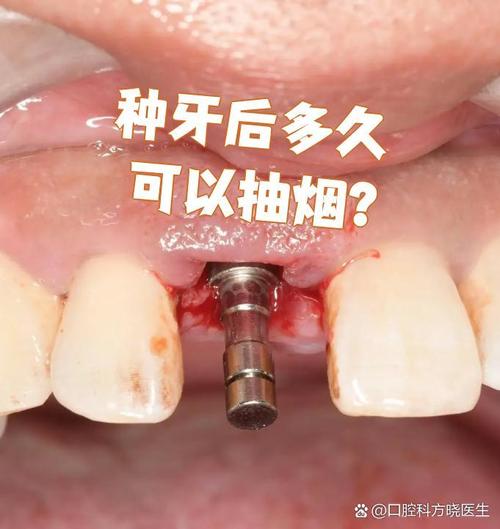 刚种牙后多久能吸烟?影响种植牙恢复吗?-图3 刚种牙后多久能吸烟?影响种植牙恢复吗?-图3