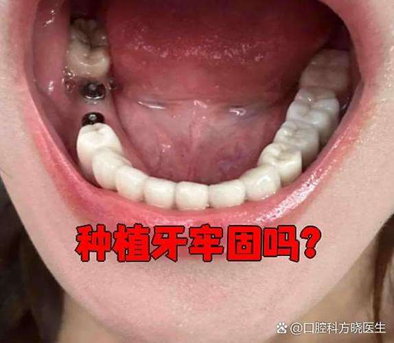 种牙失败后如何处理？这些实用方法要知道-图3