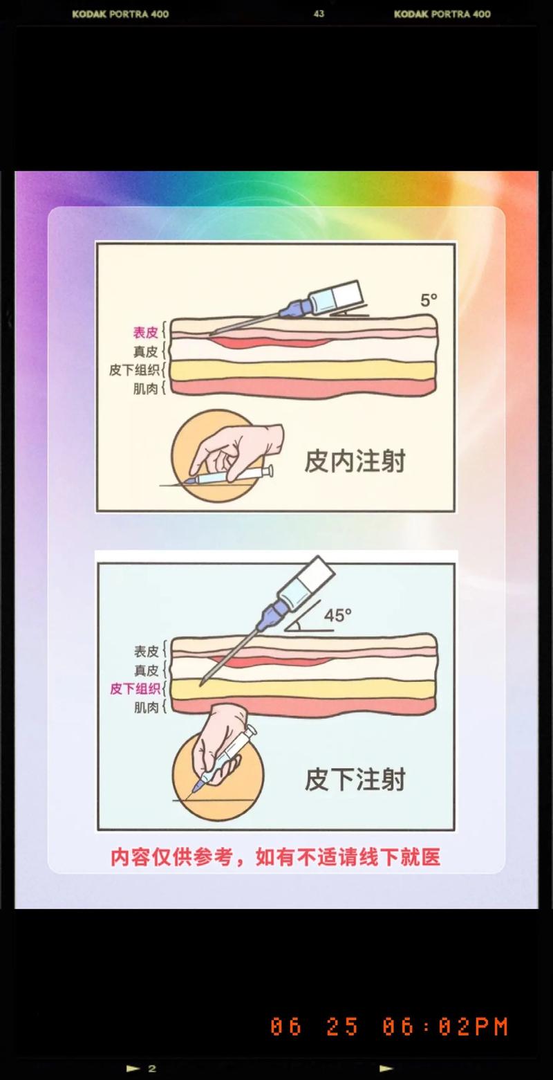 碧兰麻无痛注射方法-图2