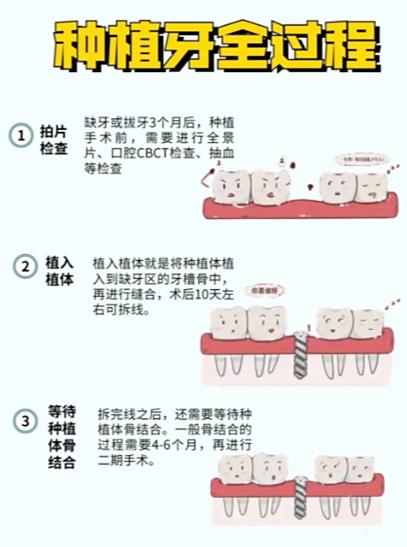 2025种牙成活率怎样？未来趋势与影响因素有哪些？-图2