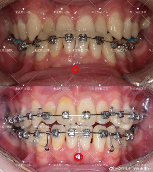 正畸压低前牙会怎么样-图1