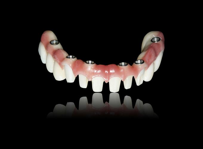 杭州种牙为何选格莱美？解答看这里？-图2