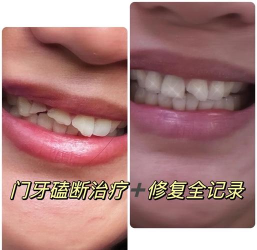 门牙磕掉后有哪些治疗方法?如何正确处理和修复?-图1 门牙磕掉后有哪些治疗方法?如何正确处理和修复?-图1