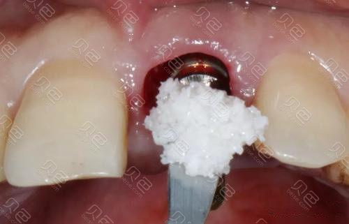 种牙植骨骨粉漏了?原因、风险与应对方法是什么?-图2 种牙植骨骨粉漏了?原因、风险与应对方法是什么?-图2