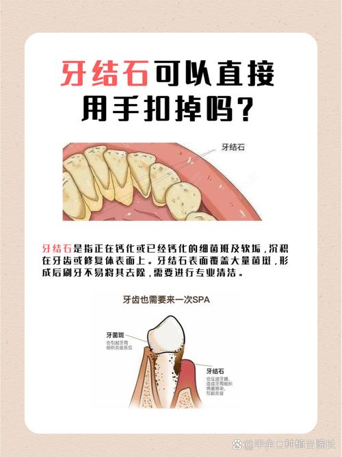 龈下结石去除方法有哪些?专业牙医详解步骤与注意事项解析-图2 龈下结石去除方法有哪些?专业牙医详解步骤与注意事项解析-图2
