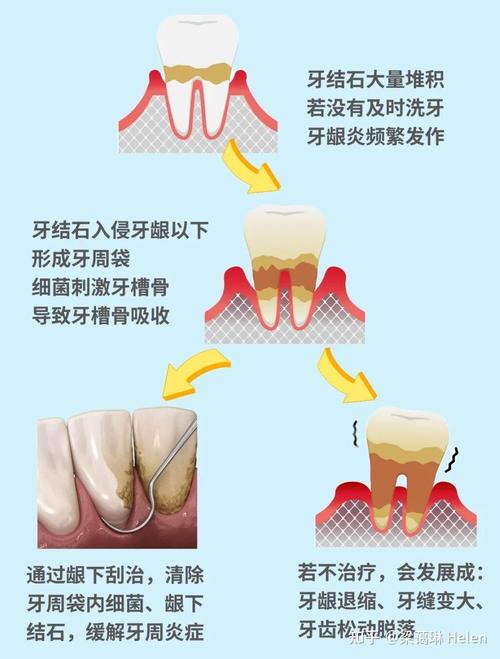 龈下结石去除方法有哪些?专业牙医详解步骤与注意事项解析-图3 龈下结石去除方法有哪些?专业牙医详解步骤与注意事项解析-图3