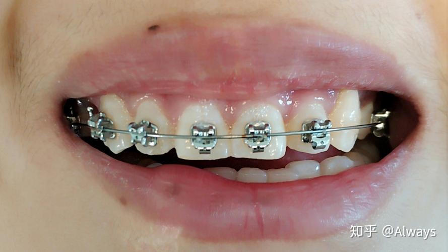 正畸自锁要换几次钢丝-图3 正畸自锁要换几次钢丝-图3